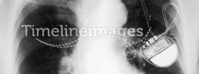 X-rayed chest