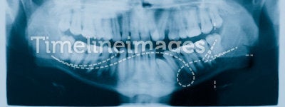 Dental Xray (x-ray)