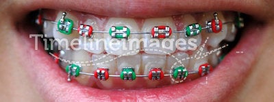 Colorful braces