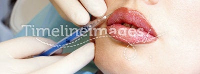 Cosmetic injection in the female lips