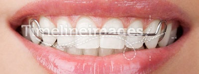 Teeth with retainer