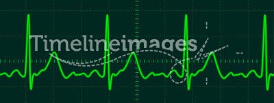 Heart monitor screen