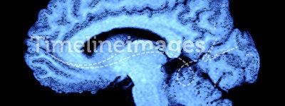 Brain MRI CT Scan