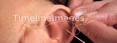 Ear acupuncture