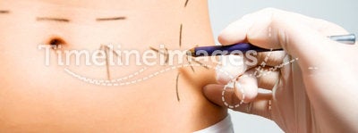 Marking abdomen for cosmetic correction surgery